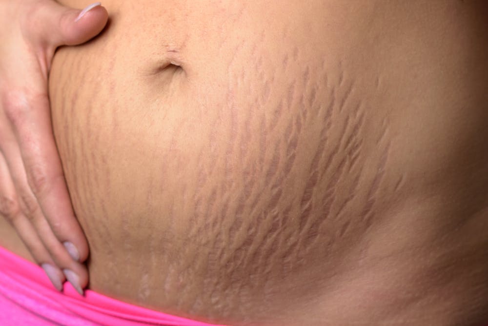Stretch Marks and Weight Loss: A Guide to Fading and Prevention thumbnail